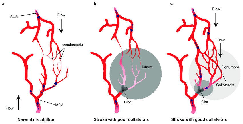 Collateral Pathways and Stroke