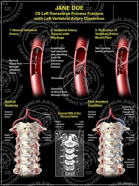 Spontaneous carotid and vertebral arterial dissection