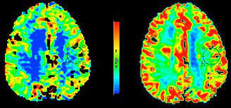 Stroke of unknown onset : imaging based selection for Reperfusion therapy